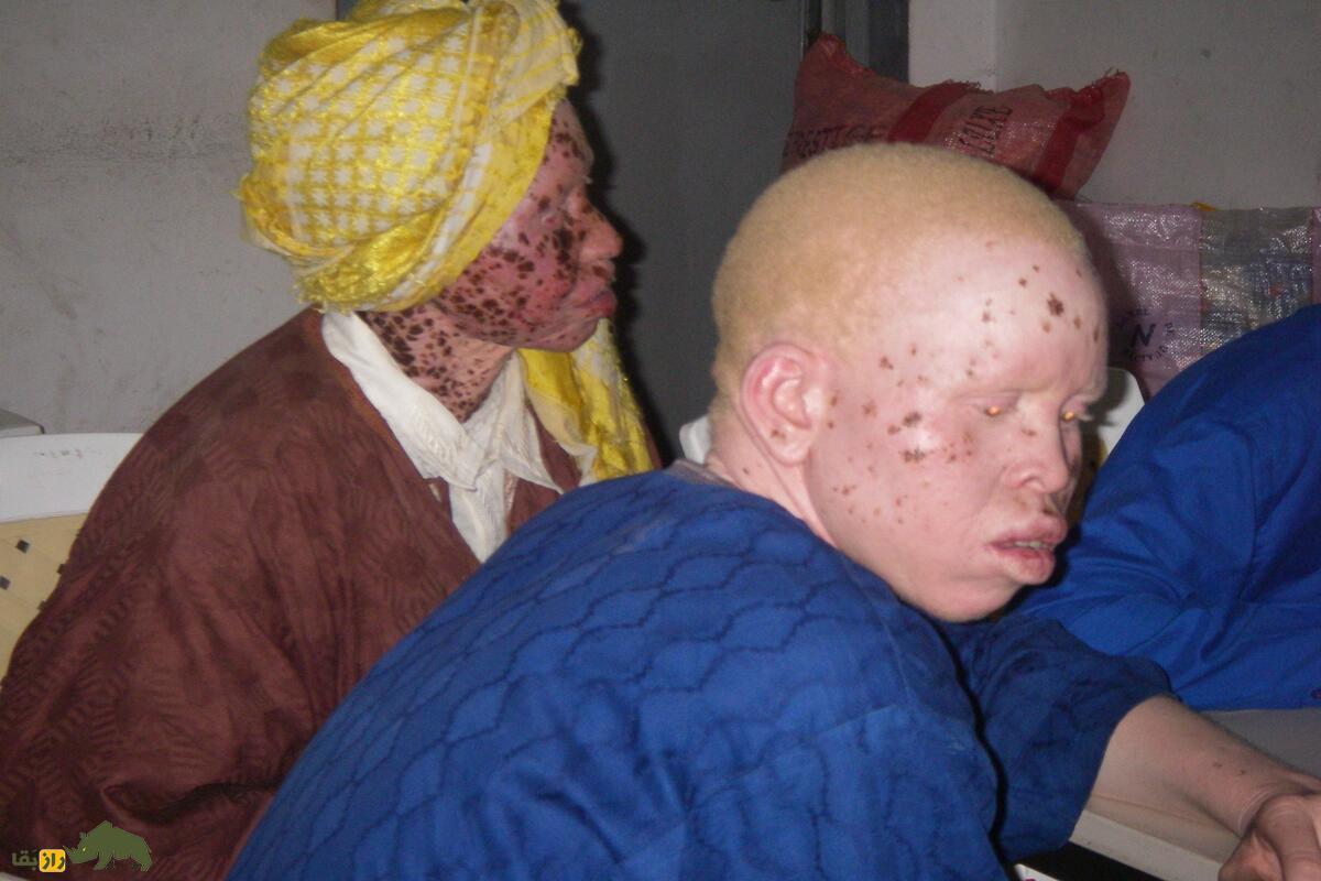 تصویری از دو کودک زال در آفریقا