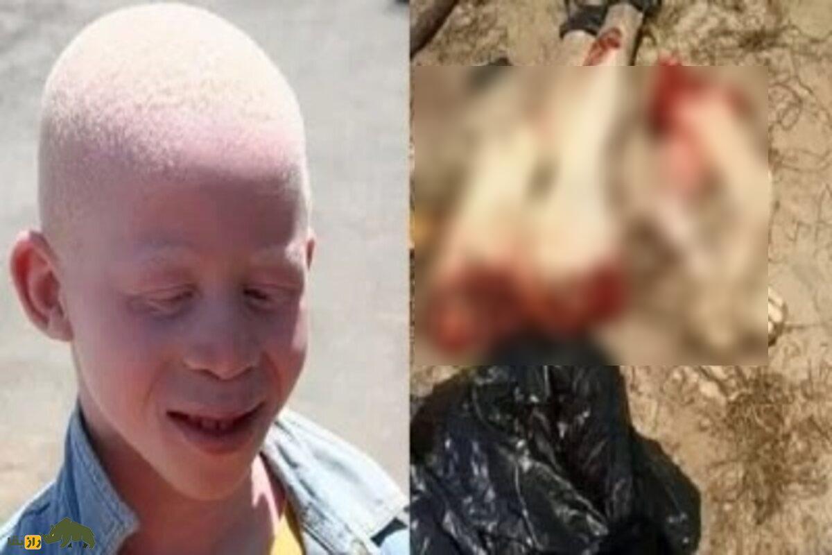 اندام قطع شده یک کودک زال در آفریقا