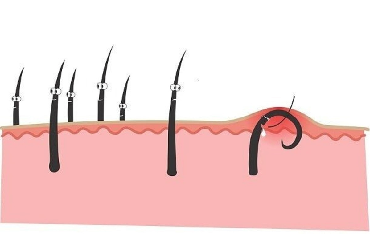 موی زیر پوستی چیست و چگونه میتوان آن را درمان کرد؟ موی زیر پوستی چیست و چگونه میتوان آن را درمان کرد؟