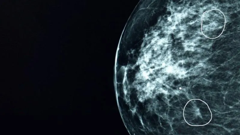 هوش مصنوعی سرطان پستان ۱۱ زن را تشخیص داد
