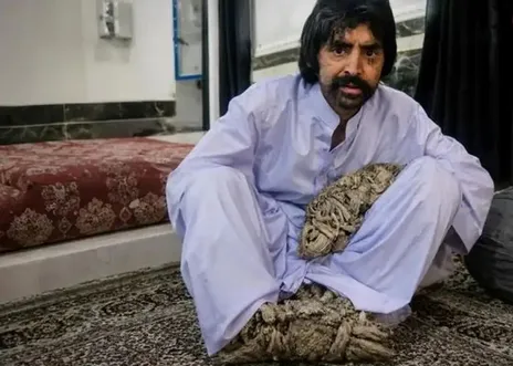 (ویدئو) عبدالنصیر معروف به مرد درختی به آمریکا رسید؛ لقمان روزجنگ به قولش عمل کرد